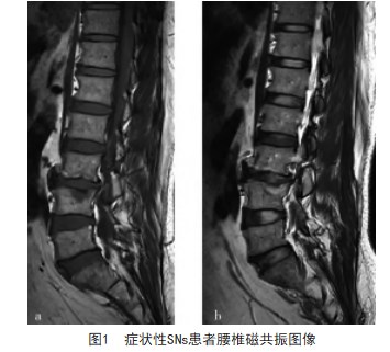 症状性许莫氏结节治疗的研究进展论文