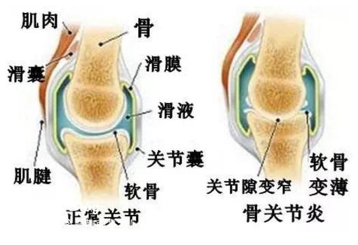 膝盖关节炎有救了,家有的人可以记得存起来,确实不错
